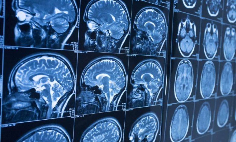 فناوری MRI ارتباط بین فعالیت مغز و روان‌شناسی را کشف می‌کند