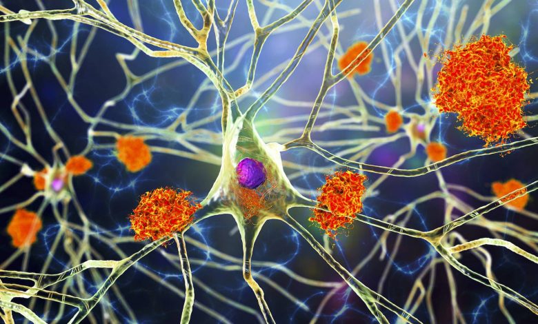 پژوهشگران می‌گویند علت بیماری آلزایمر پلاک‌های آمیلوئید بتا نیست