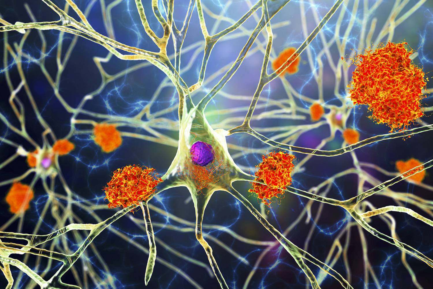 پژوهشگران می‌گویند علت بیماری آلزایمر پلاک‌های آمیلوئید بتا نیست
