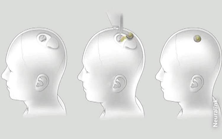 ویدئویی از آغاز فاز آزمایش ایمپلنت مغز بر روی انسان توسط نورالینک