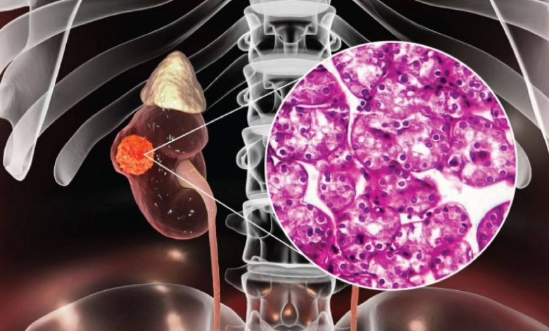 سرطان کلیه چیست و چه علائمی دارد؟