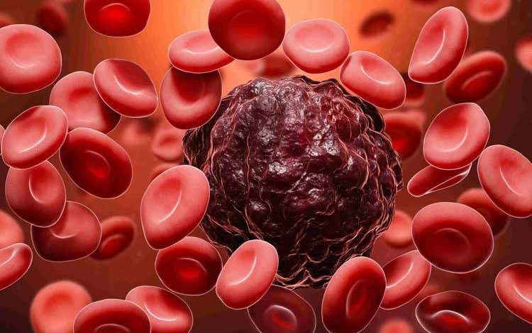 روش جدید نوردرمانی در نیم ساعت، ۹۰ درصد از سلولهای سرطانی را از بین میبرد