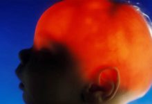 مورد عجیب الکس سیمپسون؛ نوزادی که تقریباً بدون مغز متولد شد، ۲۰ سالگی‌اش را جشن گرفت