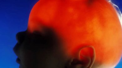 مورد عجیب الکس سیمپسون؛ نوزادی که تقریباً بدون مغز متولد شد، ۲۰ سالگی‌اش را جشن گرفت