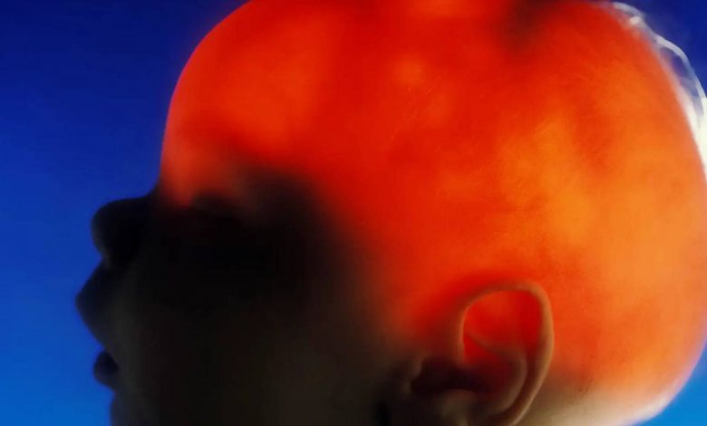 مورد عجیب الکس سیمپسون؛ نوزادی که تقریباً بدون مغز متولد شد، ۲۰ سالگی‌اش را جشن گرفت