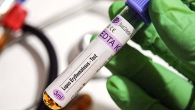 کشف قوی‌ترین شواهد از نقش ویروس اپشتین بار در بروز بیماری لوپوس