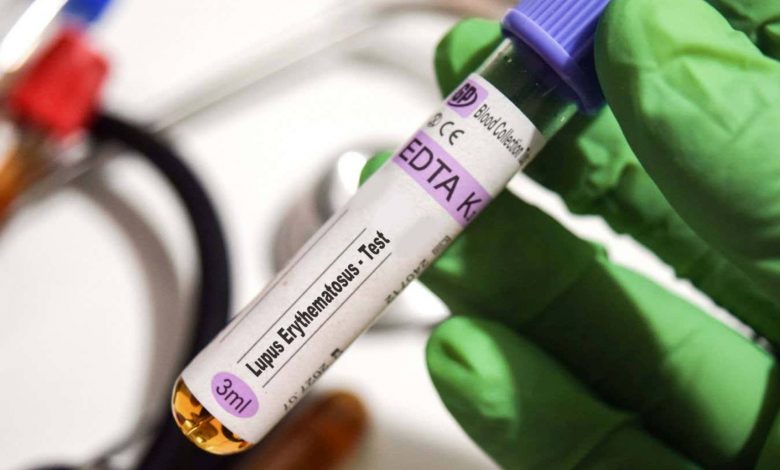 کشف قوی‌ترین شواهد از نقش ویروس اپشتین بار در بروز بیماری لوپوس