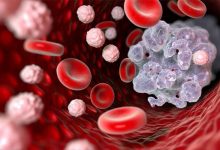 ۴ نشانه عجیب سرطان که هرگز نباید نادیده بگیرید