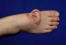 پزشکان چینی در موردی بی‌سابقه، گوش بیمار را به پایش پیوند زدند