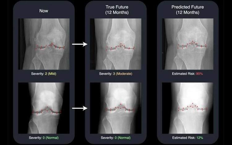 تشخیص زودهنگام آرتروز با هوش مصنوعی؛ تصویری از زانوی یک سال بعد